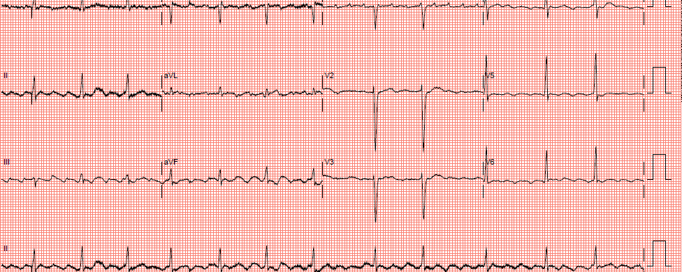 ECG dyspnoe